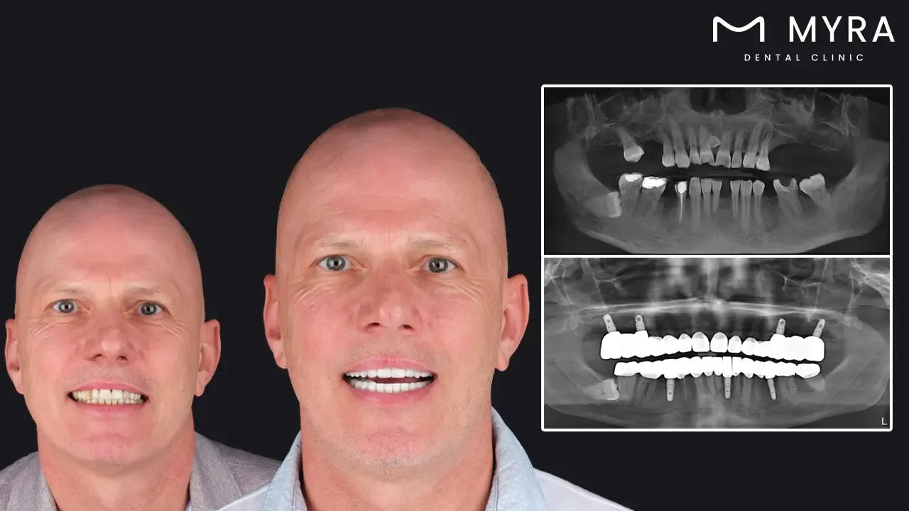 Can the material used in dental implants influence the overall limit_.webp